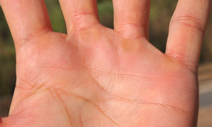 Hand Injury-5