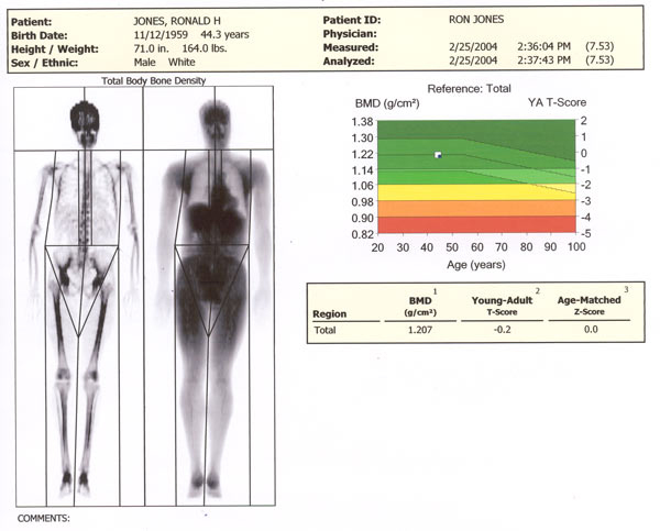 RJ-DEXA BMD